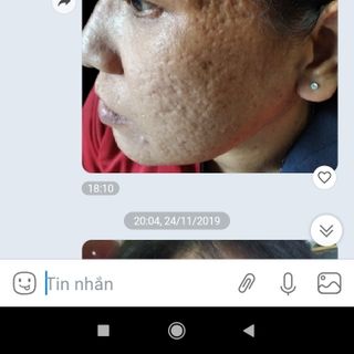 Serum tái tạo da trị mụn thâm trắng da trị rỗ se khít lỗ chân lông