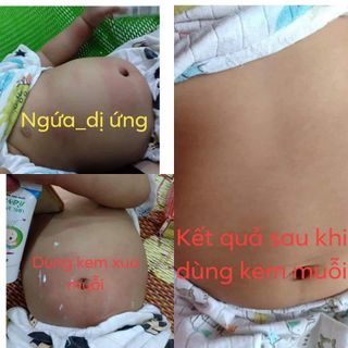 Kem Muỗi baby love skin