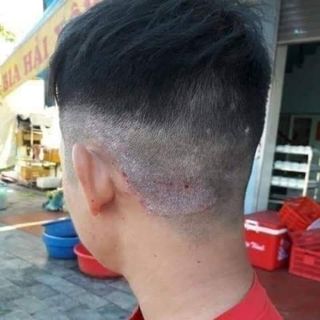 Thuốc Trị Dứt Điểm Gàu và Nấm Da Đầu
