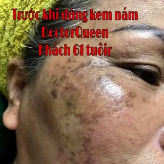 KEM TRỊ NÁM DOCTOR QUEEN 30G