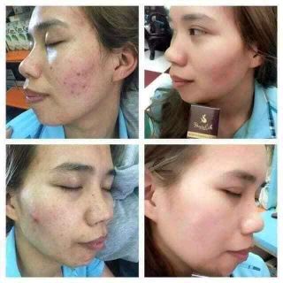 kem trị mụn Huyền Cò