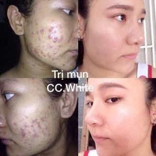 Kem trị mụn CC White trị mụn viêmmụn mủmụn bọc hiệu quả