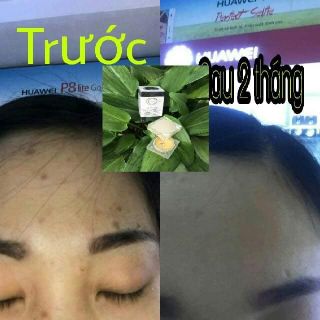 Kem trị thâm CC White trị thâm do mụn côn trùng