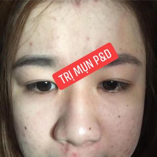 Thuốc trị mụn PD