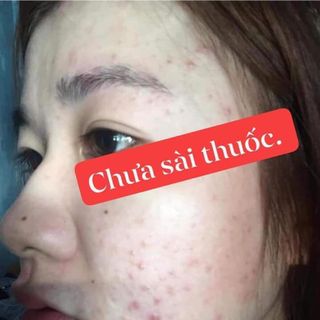 Thuốc trị mụn PD