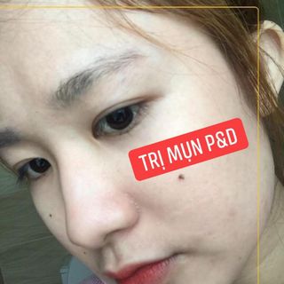 Thuốc trị mụn PD