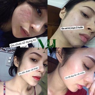 Trị mụn Dr.MAI Mix Saffron