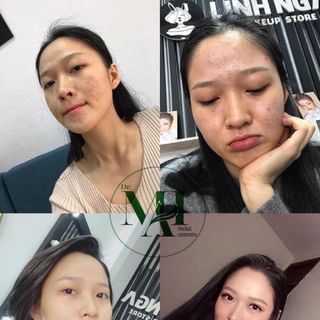 Trị mụn Dr.MAI Mix Saffron