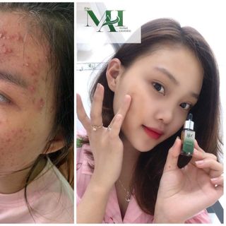 Trị Mụn Dr.MAI nguyên chất