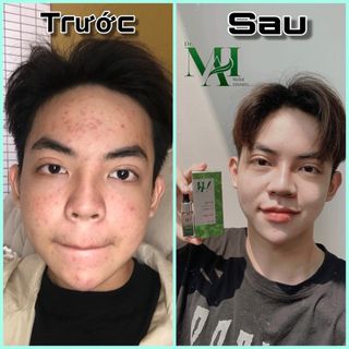 Trị Mụn Dr.MAI nguyên chất