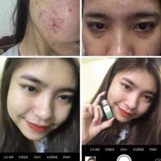 Trị Mụn Dr.MAI nguyên chất