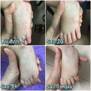 Kem bôi muỗi Thái Lan