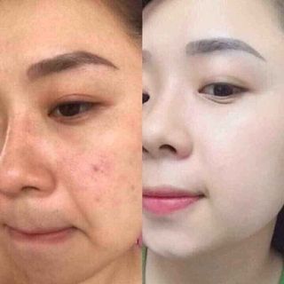 Combo trị mụn, nám