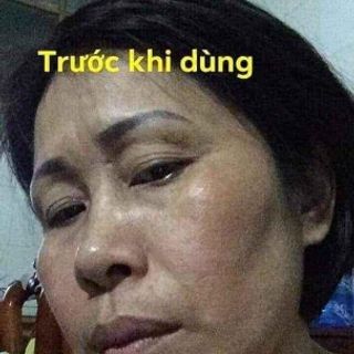 Cao đặt trị nám tàn nhang
