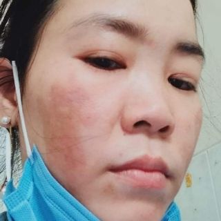 Cao đặt trị nám tàn nhang