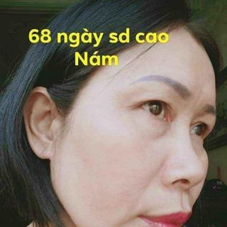 Cao đặt trị nám tàn nhang