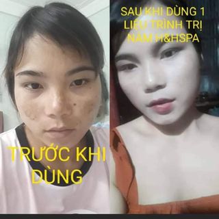 Cao đặt trị nám tàn nhang
