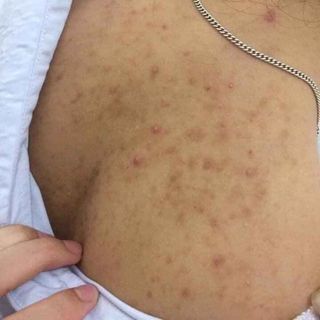 Bột thảo mộc trị mụn
