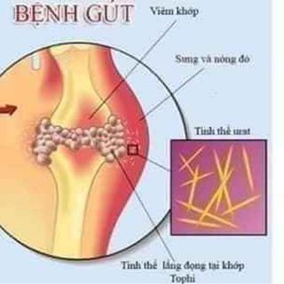 Jointlink sản phẩm hổ trợ điều trị về sương khớp