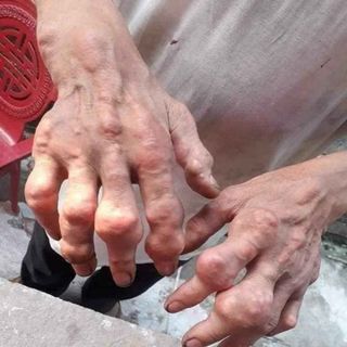 Jointlink sản phẩm hổ trợ điều trị về sương khớp