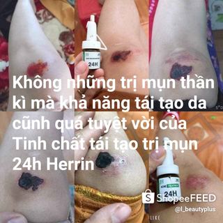 Trị mụn 24h Herrin Care - Tinh chất tái tạo 24h