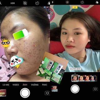 DR MAI VUA TRỊ MỤN