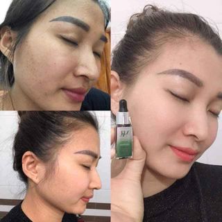 DR MAI VUA TRỊ MỤN