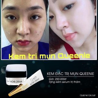KEM ĐẶC TRỊ MỤN QUEENIE SKIN