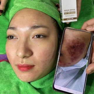 Serum Detox Acnes For Skin Ngăn Ngừa Mụn Doctor Queen