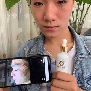 Serum Detox Acnes For Skin Ngăn Ngừa Mụn Doctor Queen