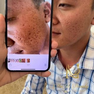 Peel tca trị sẹo rỗ