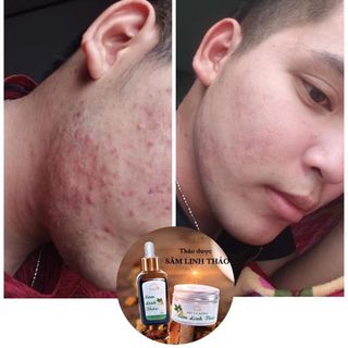 Sâm Linh Thảo - đặc trị MỤN, NÁM, TÀN NHANG từ thiên nhiên