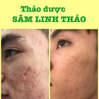 Sâm Linh Thảo - đặc trị MỤN, NÁM, TÀN NHANG từ thiên nhiên