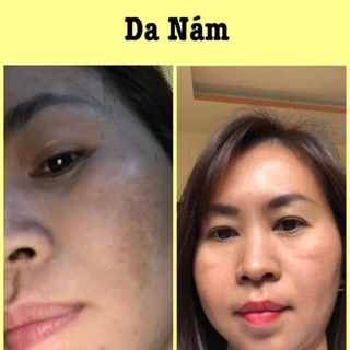Sâm Linh Thảo cao cấp - đặc trị nám, tàn nhang, sẹo rỗ