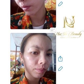 Peel tca Peel da trị nám Peel da tái tạo