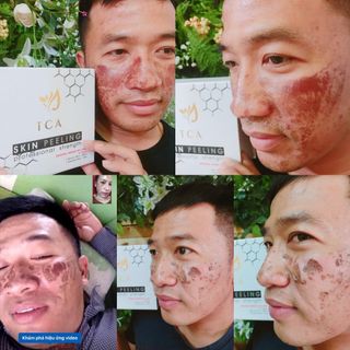Peel tca Peel da trị nám Peel da tái tạo