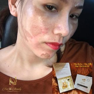 Peel tca Peel da trị nám Peel da tái tạo