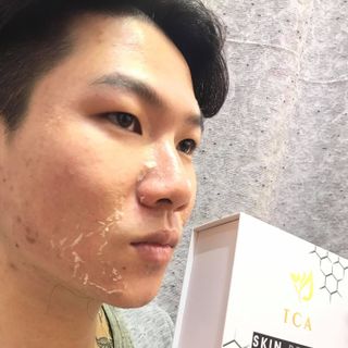 Peel tca Peel da trị nám Peel da tái tạo