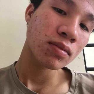 TRỊ MỤN NGỌC SÂM ĐÔNG Y
