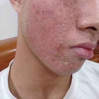 TRỊ MỤN NGỌC SÂM ĐÔNG Y