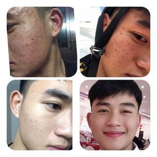TRỊ MỤN NGỌC SÂM ĐÔNG Y