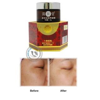Vua trị nám nhật... chuẩn tem
