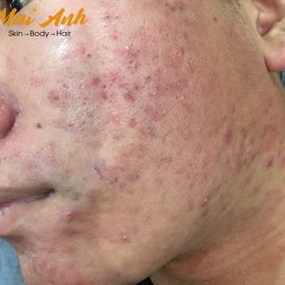 Thuốc Điều Trị Mụn Nám