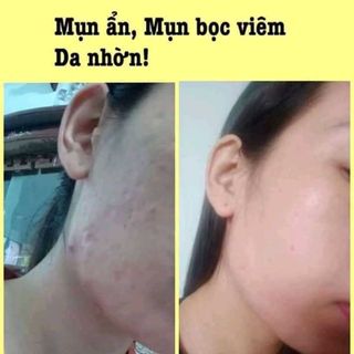 Sâm Linh Thảo - Đặc trị mụn, lỗ chân lông, sẹo rỗ