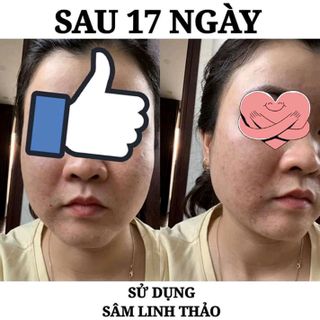 Sâm Linh Thảo - Đặc trị mụn, lỗ chân lông, sẹo rỗ