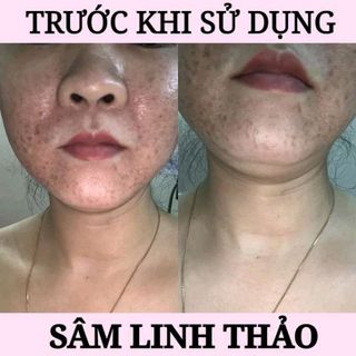 Sâm Linh Thảo - Đặc trị mụn, lỗ chân lông, sẹo rỗ