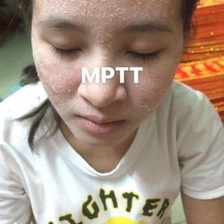 Thuốc thanh trang trị mụn