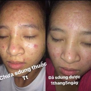 Thuốc thanh trang trị mụn