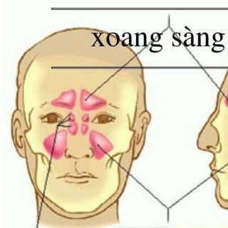 Đặc trị viêm xoang bình an