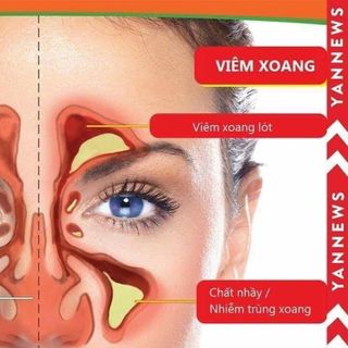 Đặc trị viêm xoang bình an